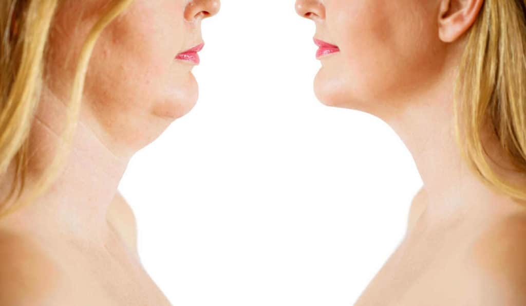 Double Chin treatment St John's Wood before and after results