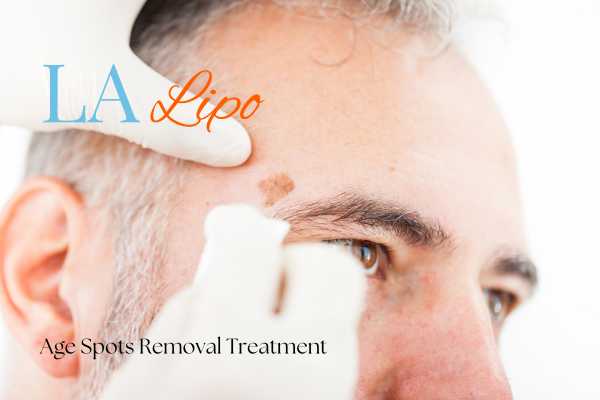 What Are the Most Effective Treatments for Age Spots St John's Wood?