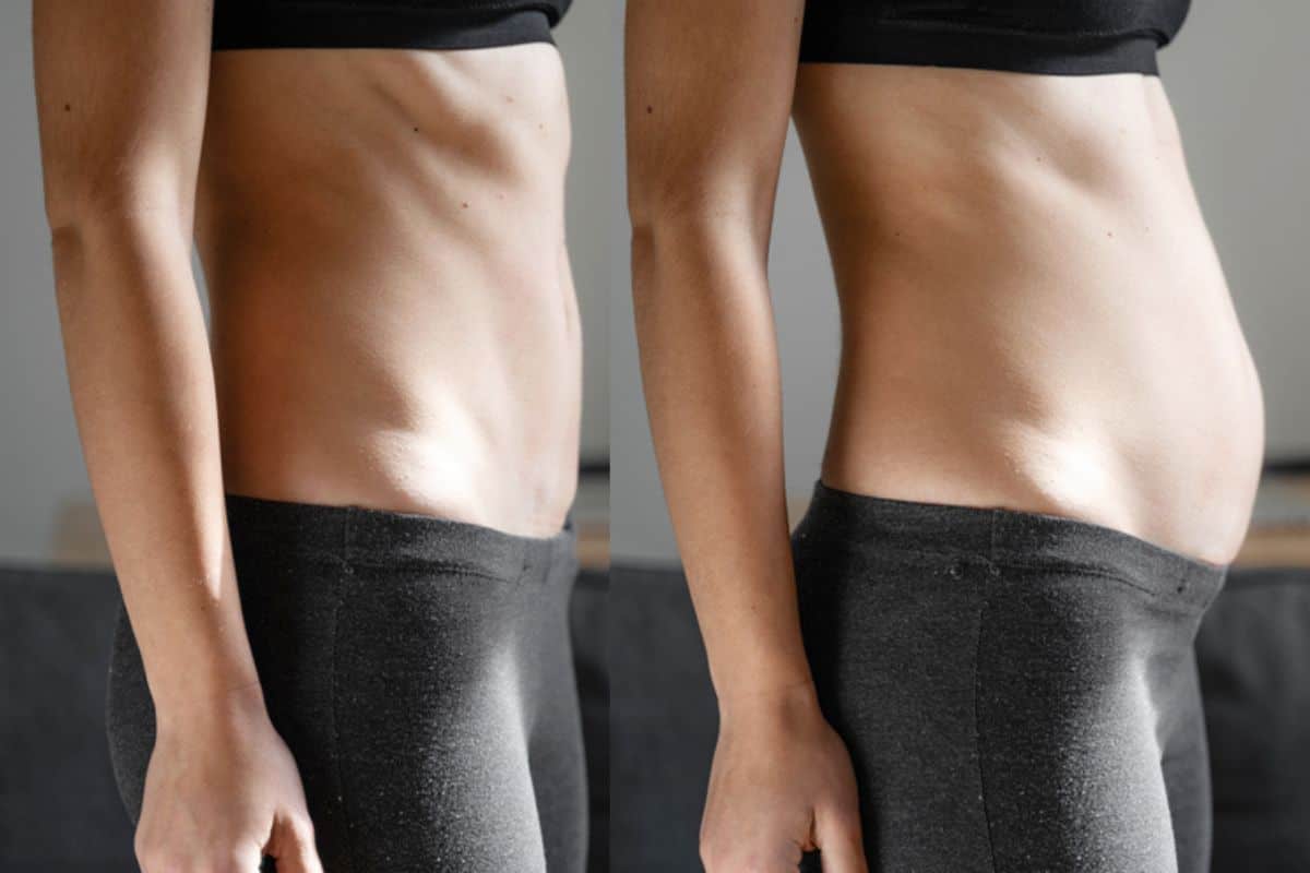 How long does diastasis recti take to improve St John's Wood?