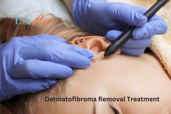 Dermatofibroma Removal Treatment St John's Wood