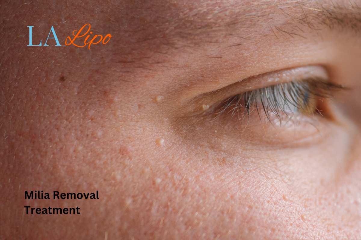 Cryopen Milia Removal: Is It the Easiest and Safest Option St John's Wood?