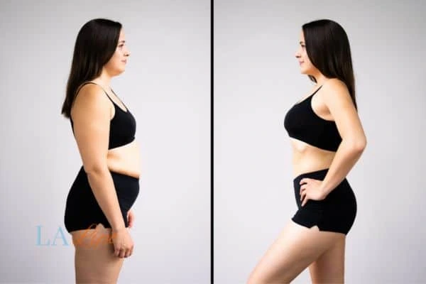 image of woman before and after results of LA-EMS Body Sculpting St John's Wood to help treat Diastasis recti