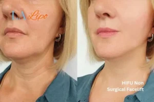 hi-fu for wrinkles St John's Wood before and after results