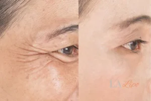 Before and after results of woman - HI-fu wrinkles reduction treatment St John's Wood
