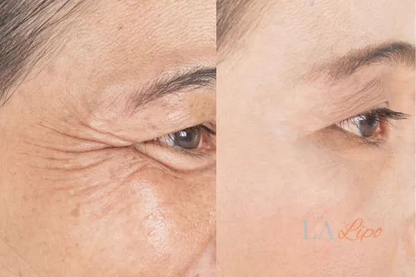 Before and after results of woman - HI-fu wrinkles reduction treatment St John's Wood