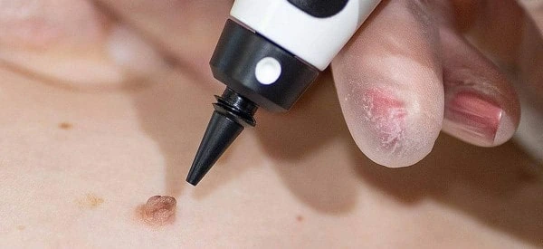 skin tag removal using cryopen St John's Wood