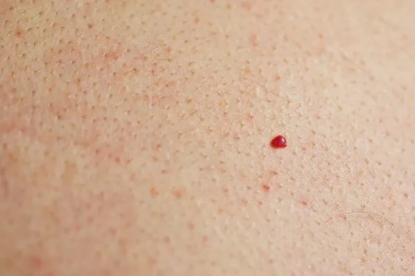 close up of a cherry angioma St John's Wood