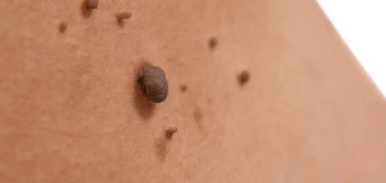 image of a skin tag St John's Wood