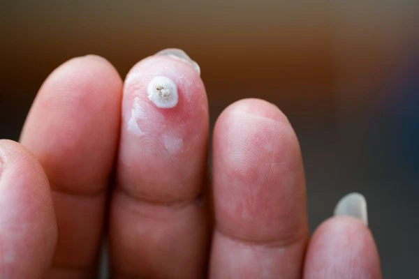 wart on person finger - cryotherapy to treat from LA LIPO St John's Wood