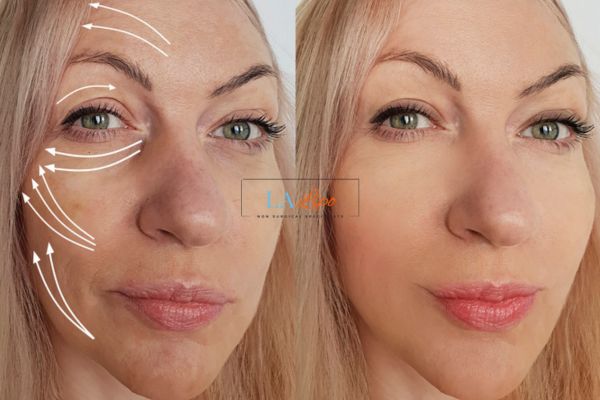 Morpheus 8 results St John's Wood face lift.