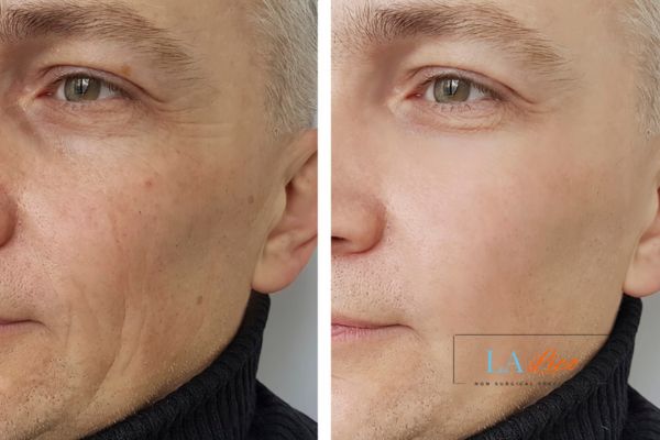 See the amazing results of Morpheus8 Treatment St John's Wood!