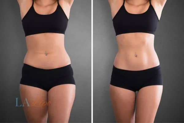 before and after results of non-surgical treatment to help a woman's body image and mental health St John's Wood
