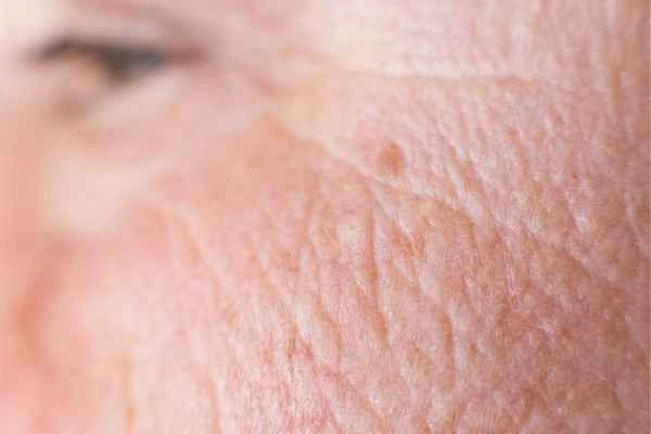 close up picture of a woman's face showing an age spot St John's Wood