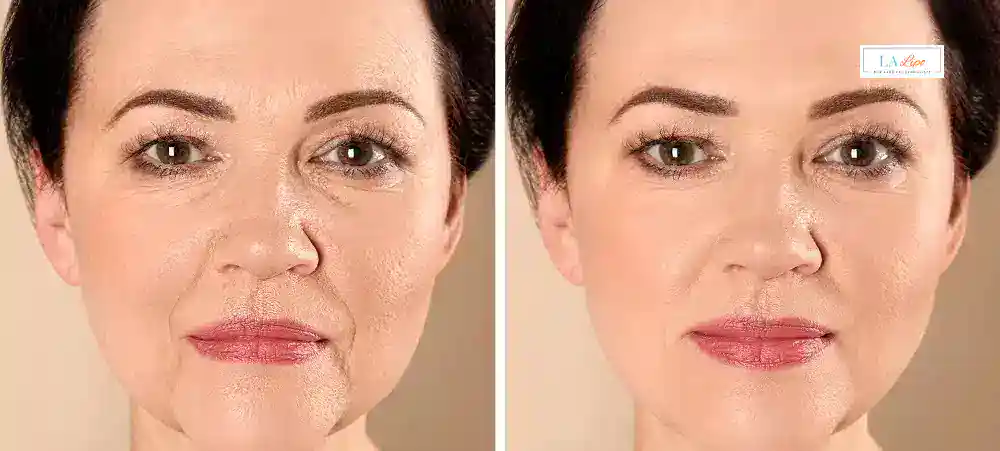 How Long Does It Take to See Results and How Long Do They Last St John's Wood?