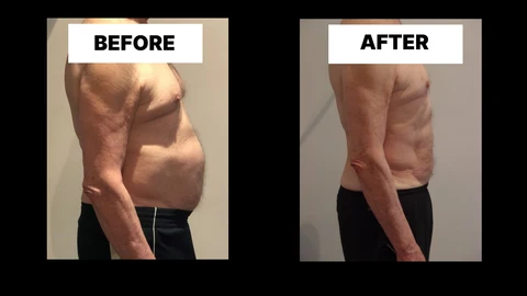 What Symptoms Can Diastasis Recti Cause in Men? Weak Core, Back Pain and Poor Posture St John's Wood